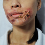 Rotten Wound