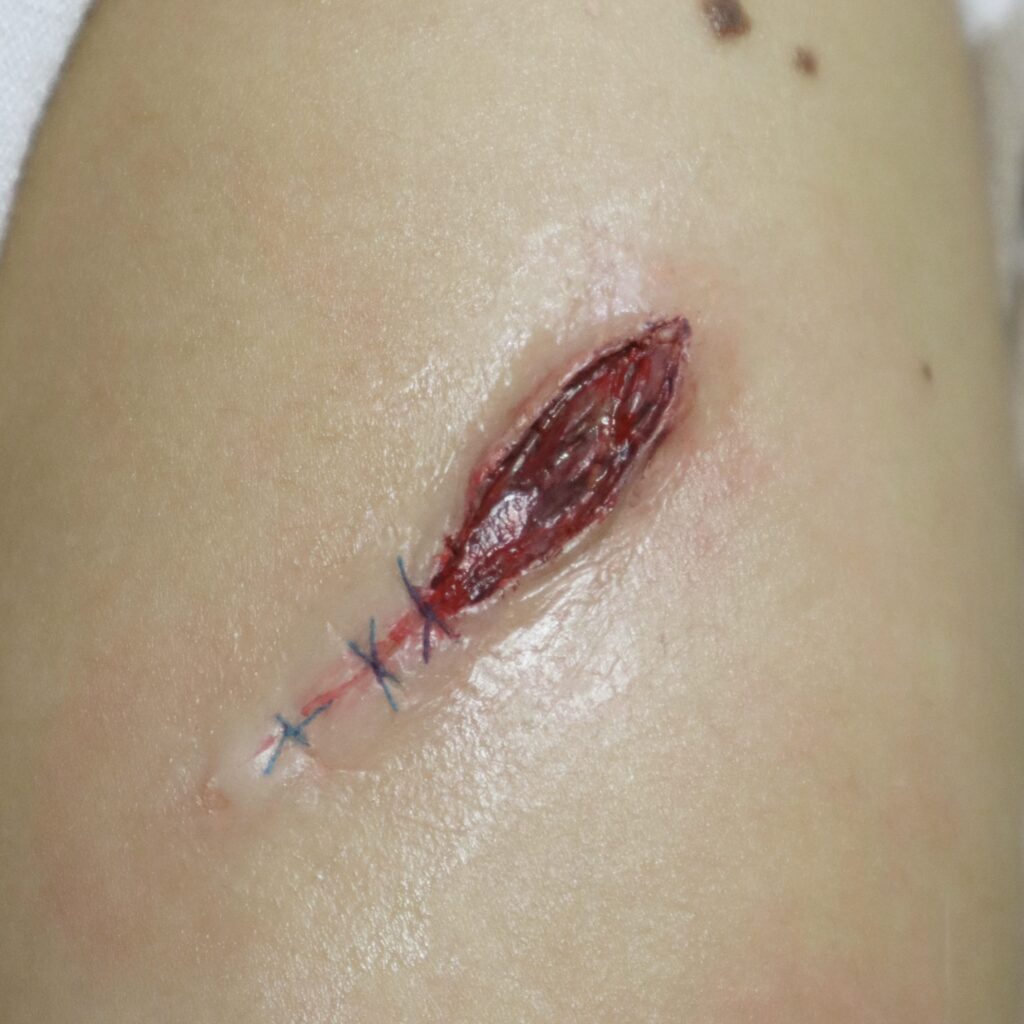 Wounds & Scars