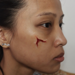 Facial Scarring