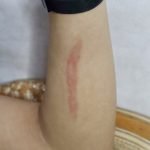 Healing Keloid & Small Healing Keloid