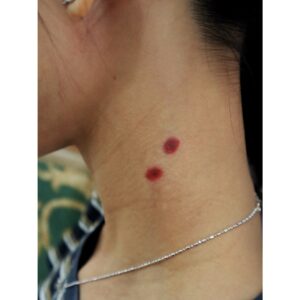 Vampire Bite Wound Temporary Tattoo – SFX Wound Effect