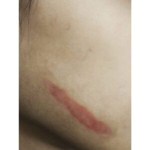 Small Healing Keloid Temporary Tattoo – SFX Body Art