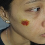 Small Healing Bruise