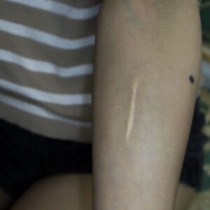 Keloid Scar Silicone Prosthetic (1 x 5 cm) – SFX & Cosplay (7 Skin Tones)