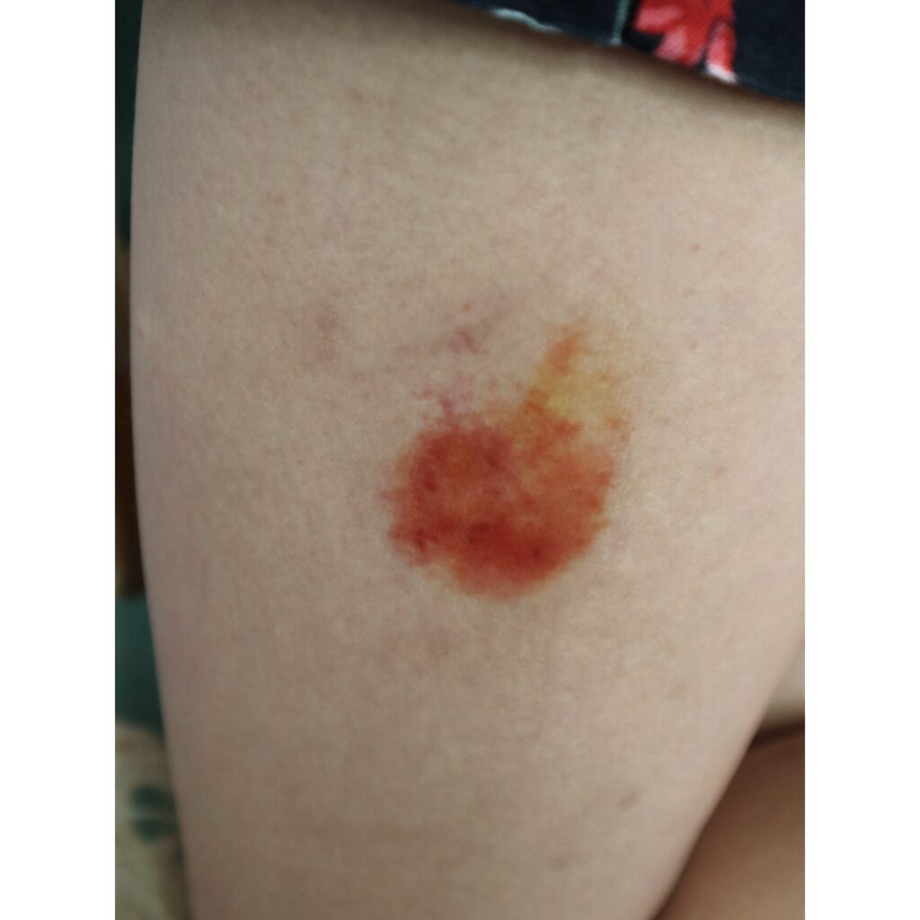 Wound Tattoos