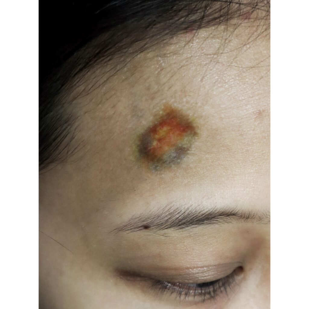 Wound Tattoos
