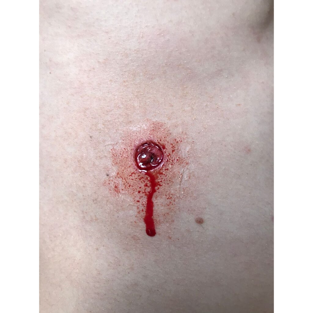 Prosthetics