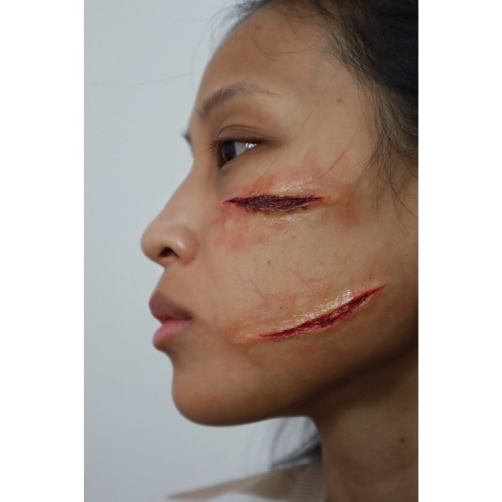 Prosthetics