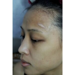 Small & Big Swelling Silicone Prosthetic – SFX & Cosplay (7 Skin Tones)