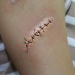 Full Stitch Silicone Prosthetic (2 x 5 cm) – SFX & Cosplay (7 Skin Tones)