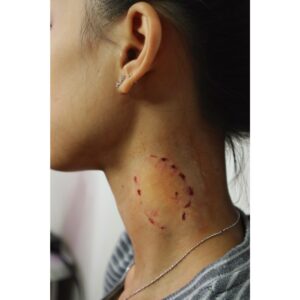 Human Bite Wound Silicone Prosthetic – SFX & Cosplay (7 Skin Tones)