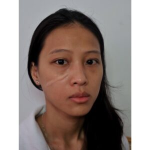 Keloid Scar Silicone Prosthetic (7.3 x 1.5 cm) – SFX & Cosplay (7 Skin Tones)