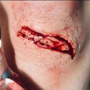Deep Laceration