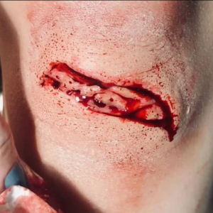 Deep Laceration