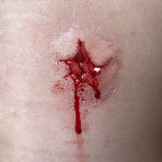 Gunshot Wound