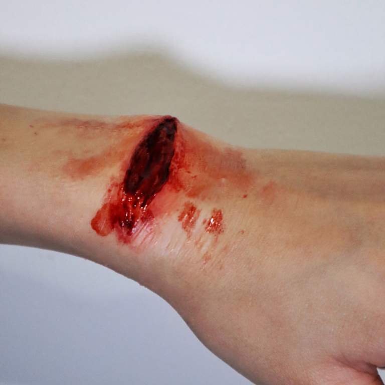 Stab Wound