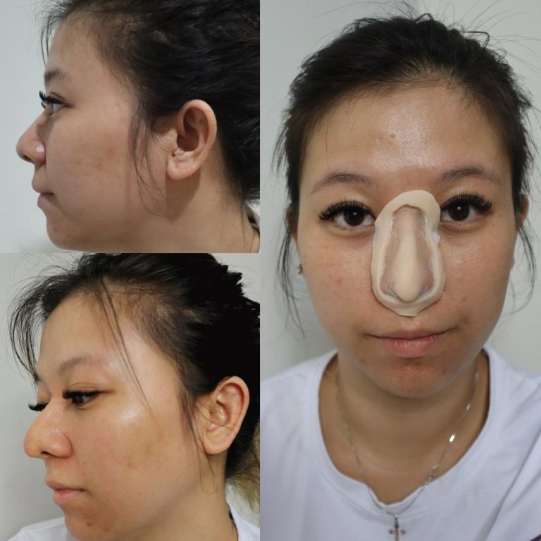 Prosthetics