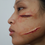 Open Wound