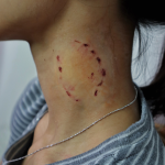 Human Bite