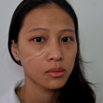Keloid