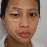 Face Burn Scarring