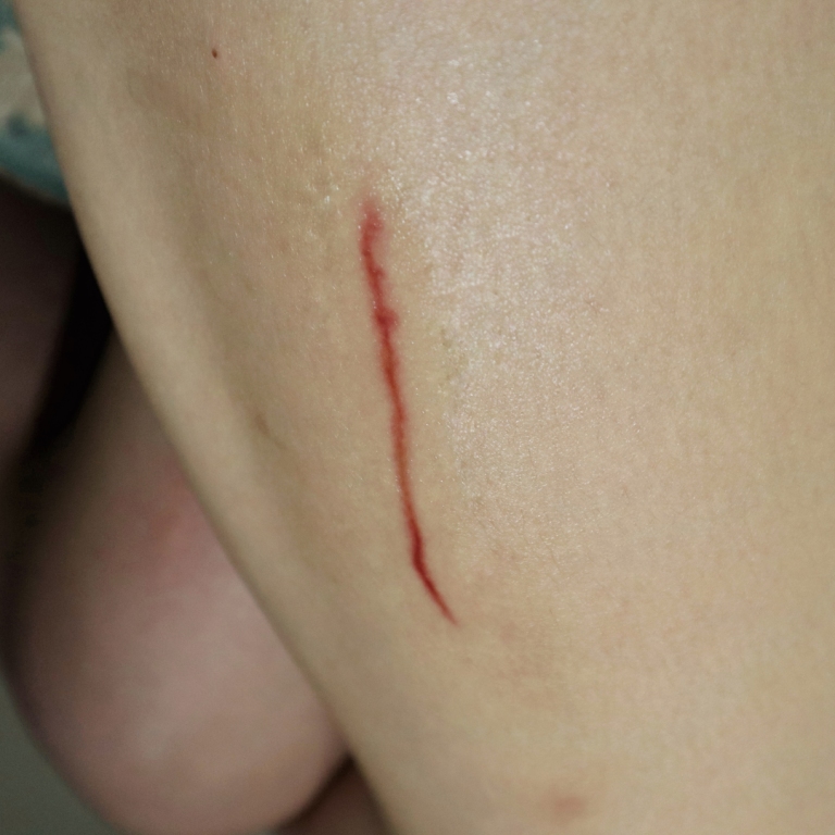 Healed Cut