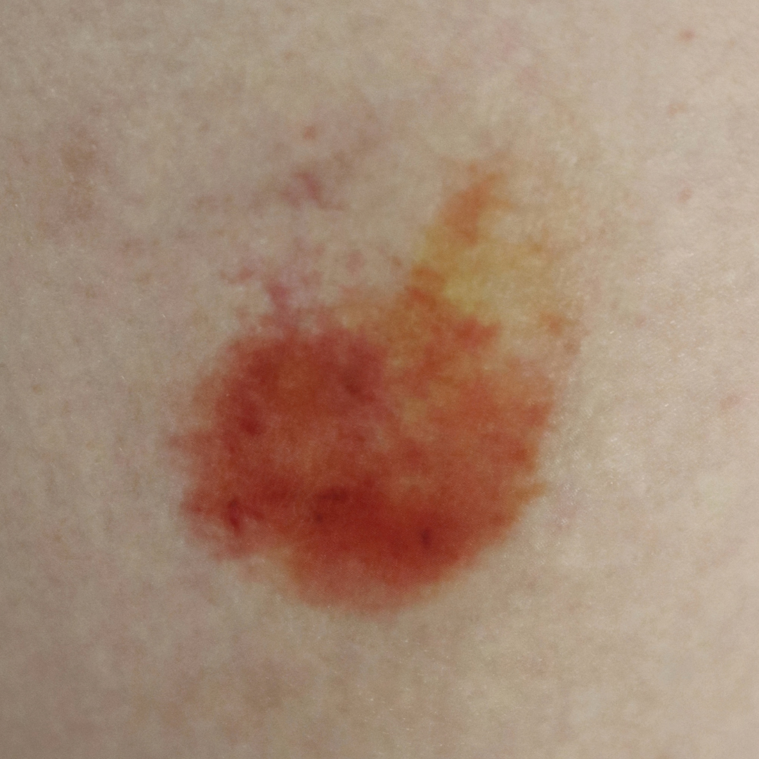 Healing Bruise 01 - Image 2