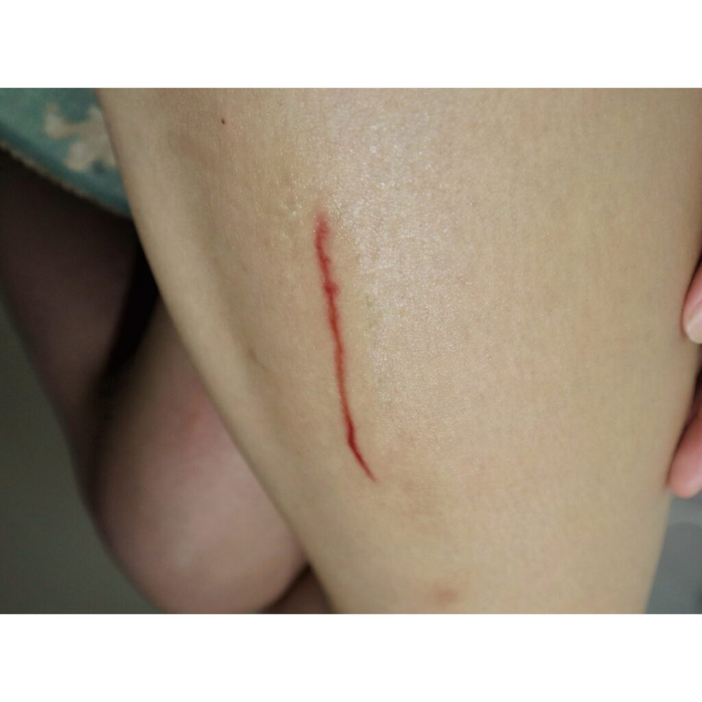 Wound Tattoos