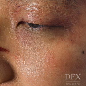 Swollen Eye Silicone Prosthetic (3.7 x 1.4 cm) – SFX & Cosplay (7 Skin Tones)