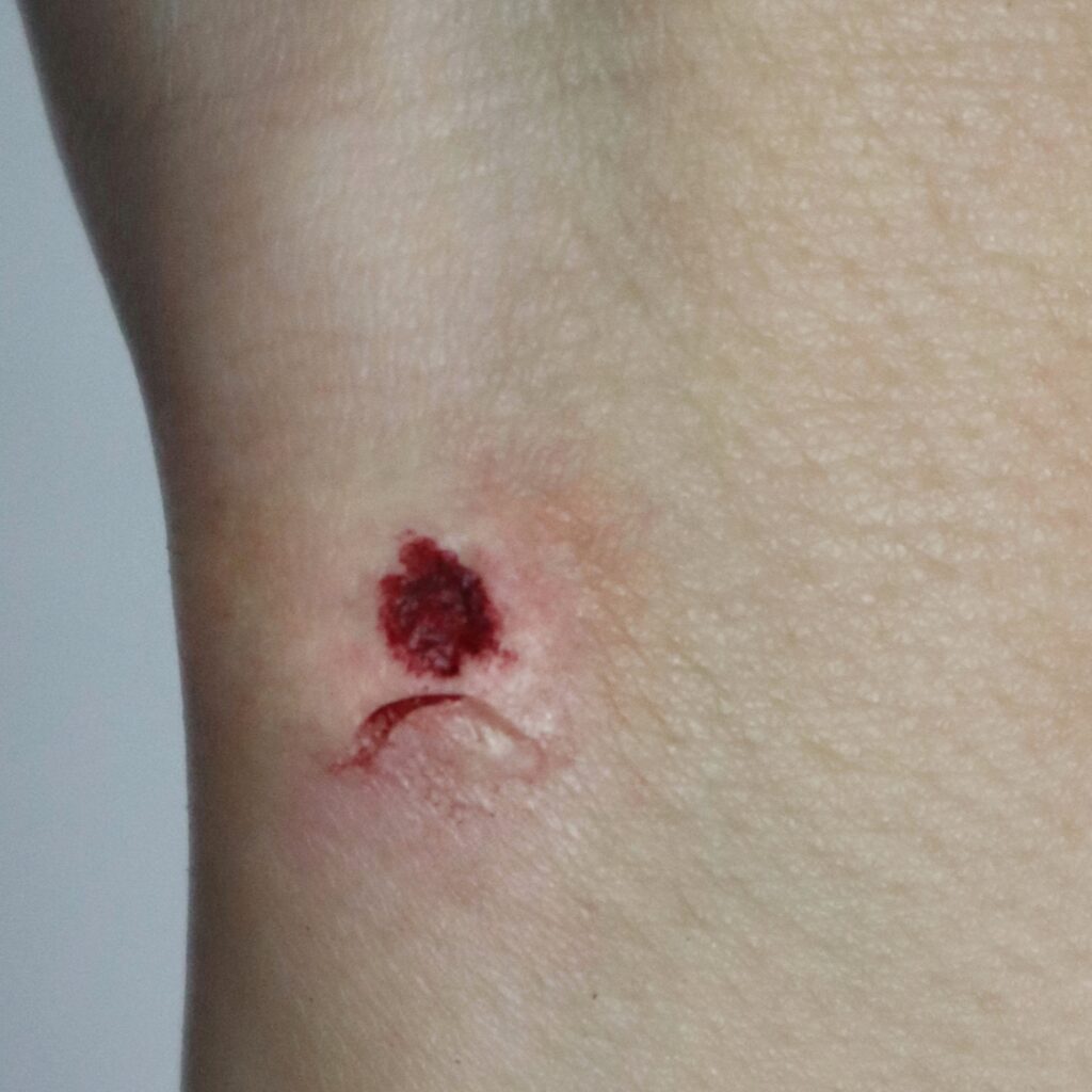 Prosthetics